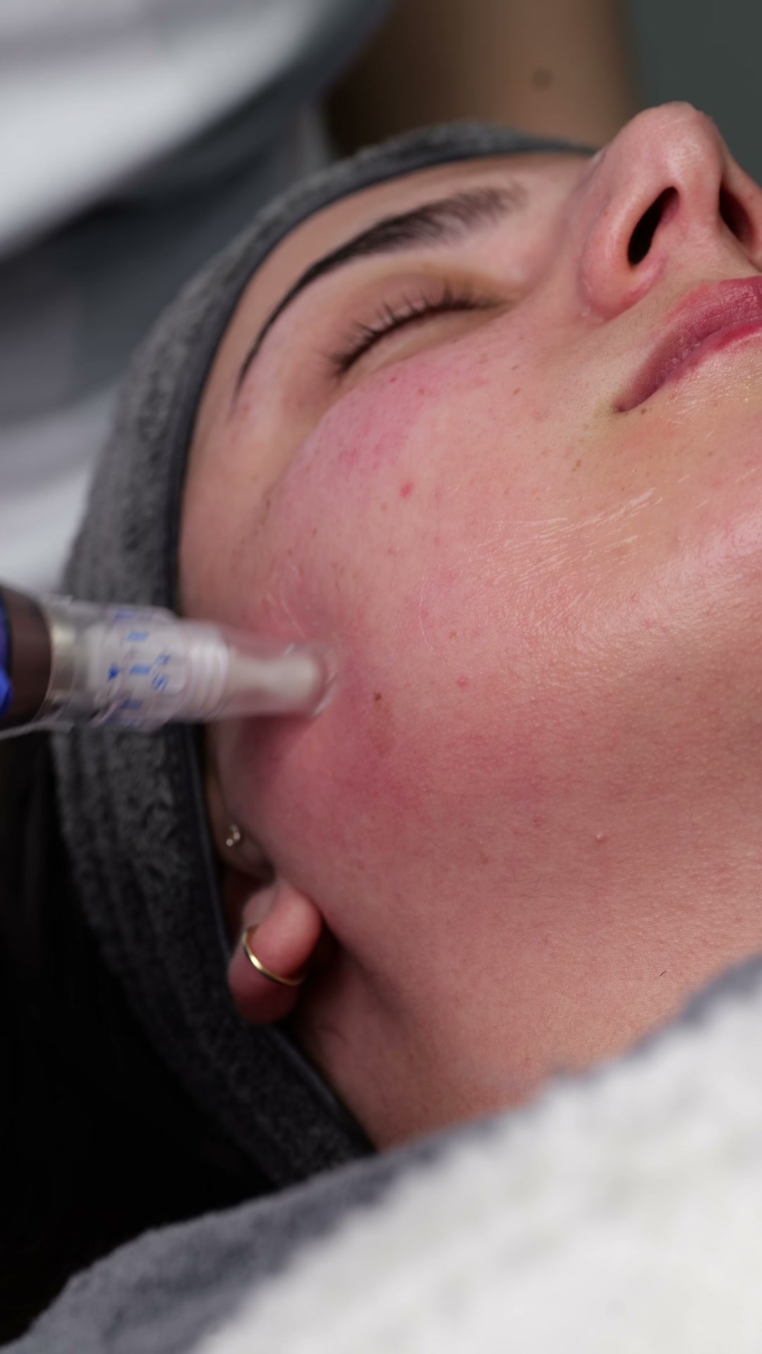 Microneedling med nålcartridge mot ansiktshud