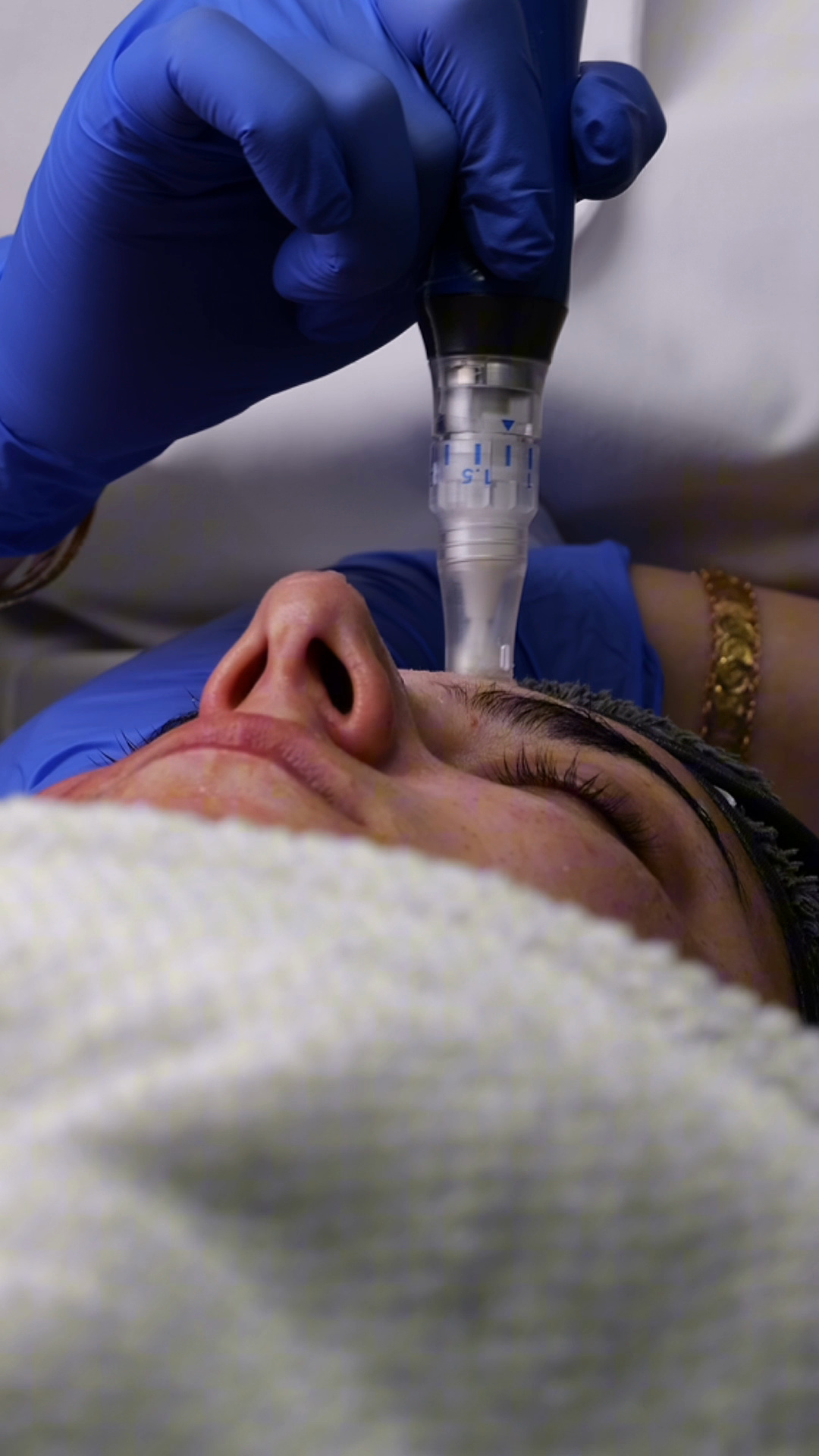 Närbild av microneedlingbehandling i ansiktet